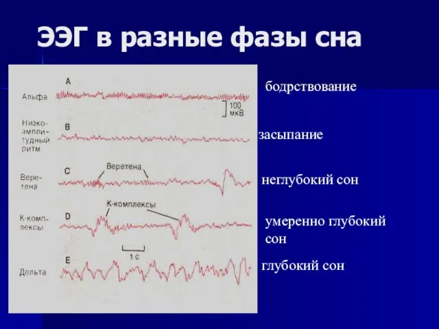 ЭЭГ в разные фазы сна бодрствование засыпание неглубокий сон умеренно глубокий сон глубокий сон