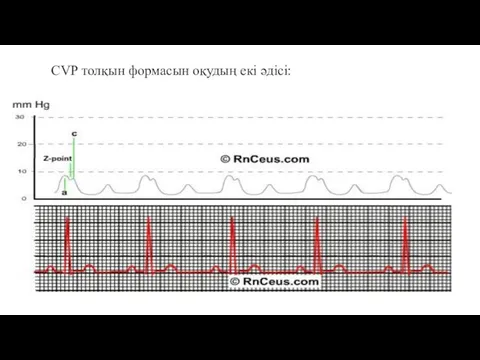 CVP толқын формасын оқудың екі әдісі: