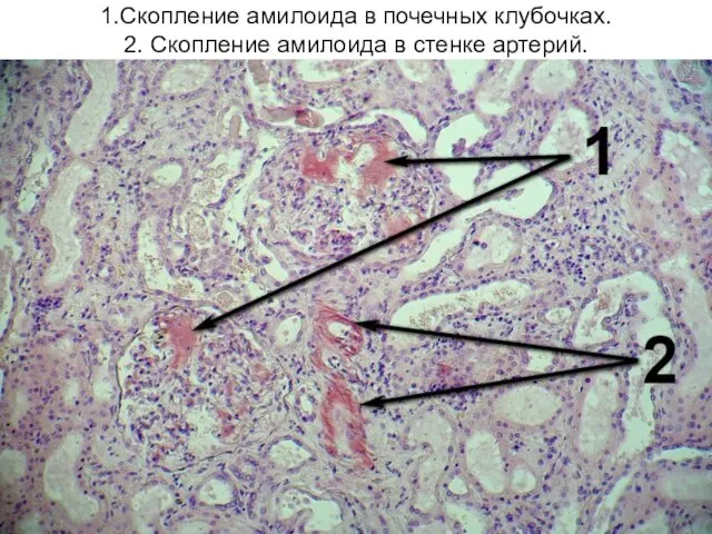 1.Скопление амилоида в почечных клубочках. 2. Скопление амилоида в стенке артерий.