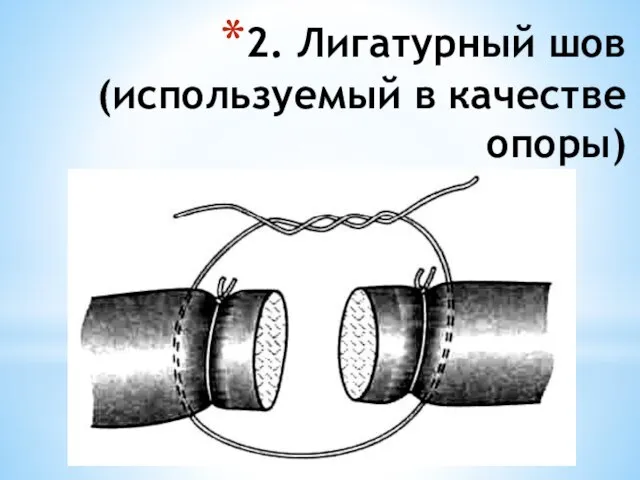 2. Лигатурный шов (используемый в качестве опоры)