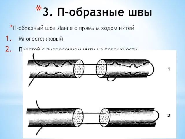 3. П-образные швы П-образный шов Ланге с прямым ходом нитей Многостежковый Простой