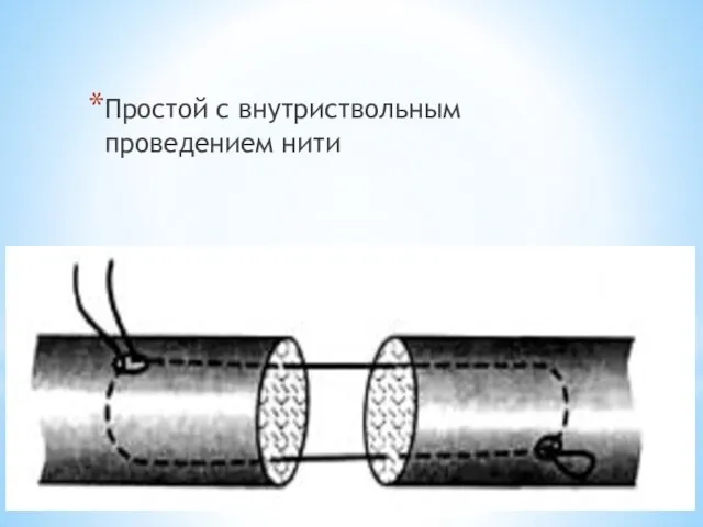 Простой с внутриствольным проведением нити