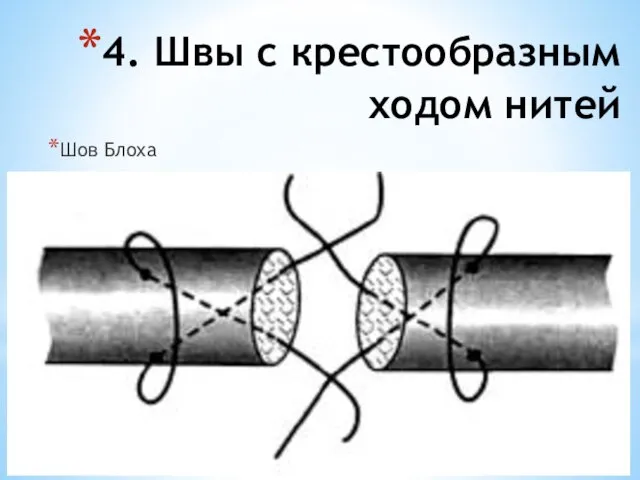 4. Швы с крестообразным ходом нитей Шов Блоха