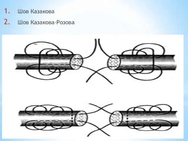 Шов Казакова Шов Казакова-Розова