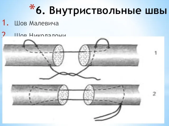 6. Внутриствольные швы Шов Малевича Шов Николадони