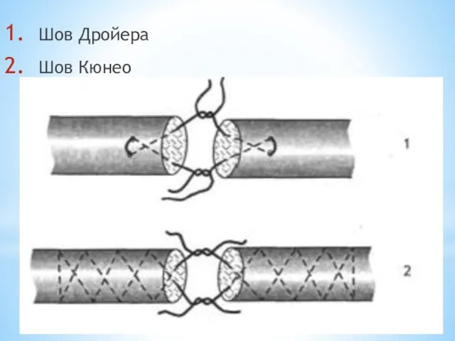 Шов Дройера Шов Кюнео