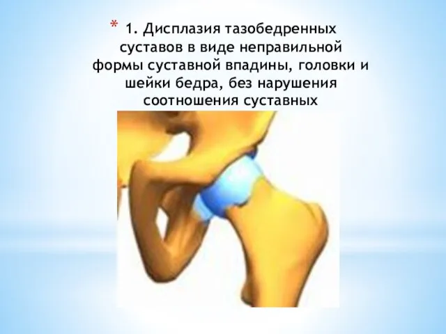 1. Дисплазия тазобедренных суставов в виде неправильной формы суставной впадины, головки и