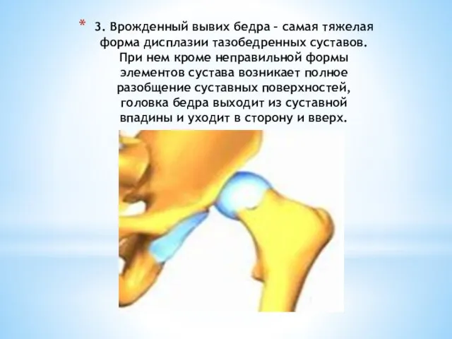 3. Врожденный вывих бедра – самая тяжелая форма дисплазии тазобедренных суставов. При