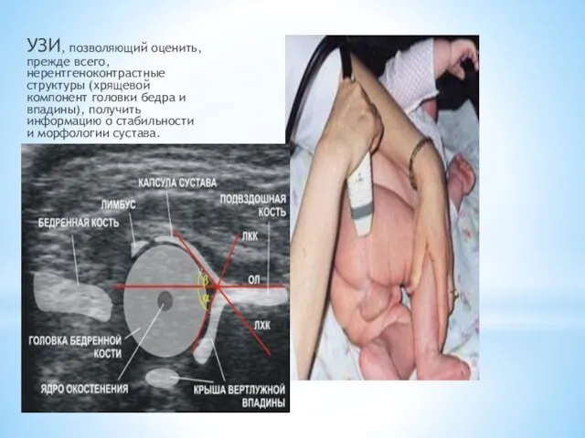 УЗИ, позволяющий оценить, прежде всего, нерентгеноконтрастные структуры (хрящевой компонент головки бедра и