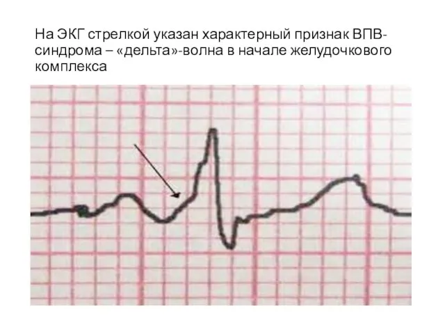 На ЭКГ стрелкой указан характерный признак ВПВ-синдрома – «дельта»-волна в начале желудочкового комплекса