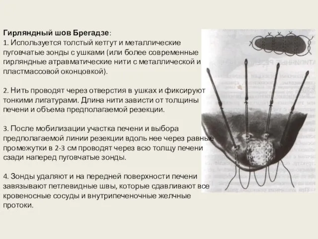 Гирляндный шов Брегадзе: 1. Используется толстый кетгут и металлические пуговчатые зонды с