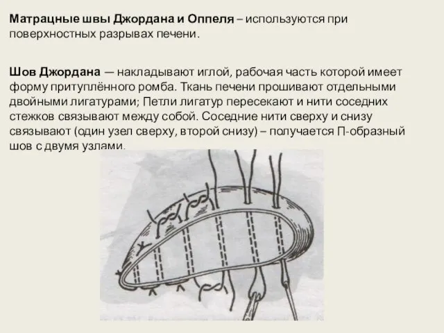 Матрацные швы Джордана и Оппеля – используются при поверхностных разрывах печени. Шов