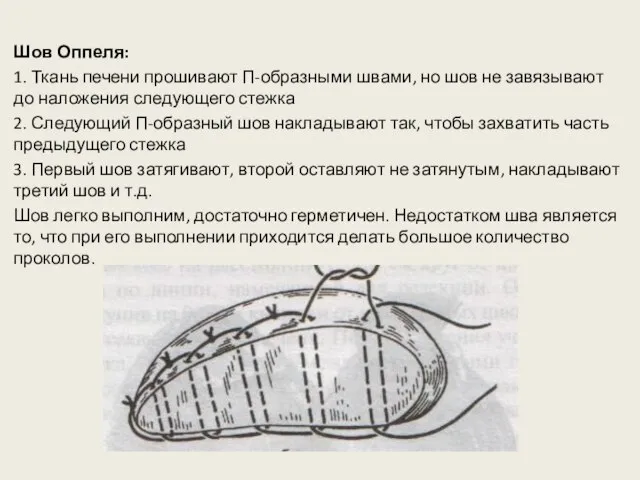 Шов Оппеля: 1. Ткань печени прошивают П-образными швами, но шов не завязывают