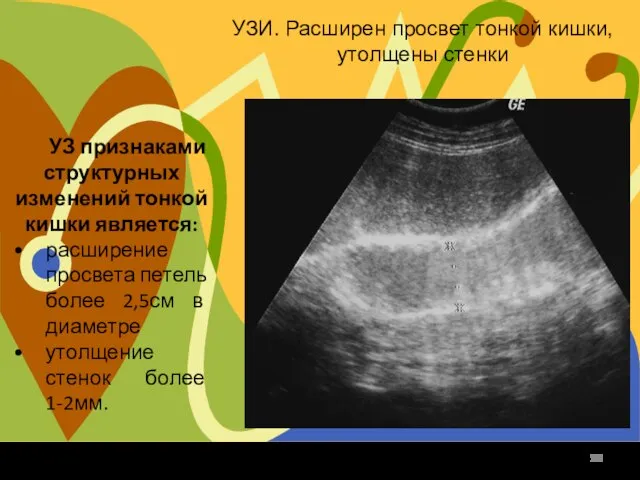 УЗИ. Расширен просвет тонкой кишки, утолщены стенки УЗ признаками структурных изменений тонкой