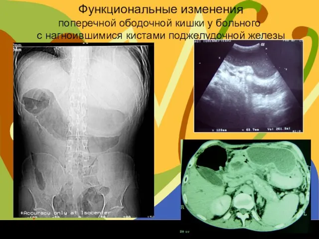 Функциональные изменения поперечной ободочной кишки у больного с нагноившимися кистами поджелудочной железы