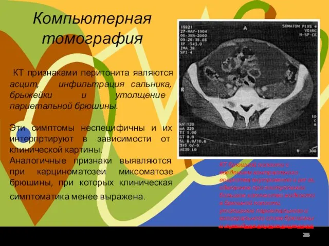 Компьютерная томография КТ признаками перитонита являются асцит, инфильтрация сальника, брыжейки и утолщение
