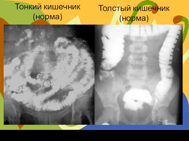 Тонкий кишечник (норма) Толстый кишечник (норма)