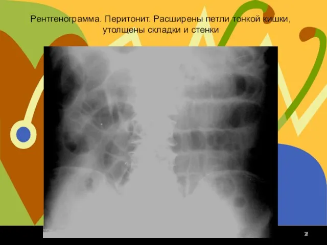 Рентгенограмма. Перитонит. Расширены петли тонкой кишки, утолщены складки и стенки