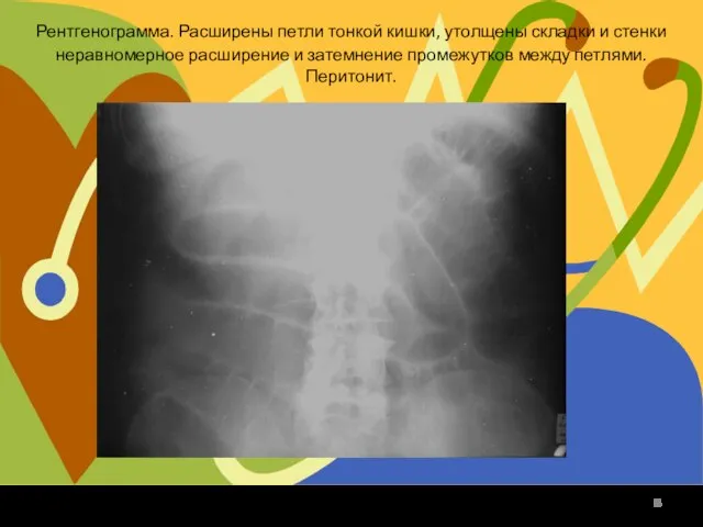 Рентгенограмма. Расширены петли тонкой кишки, утолщены складки и стенки неравномерное расширение и