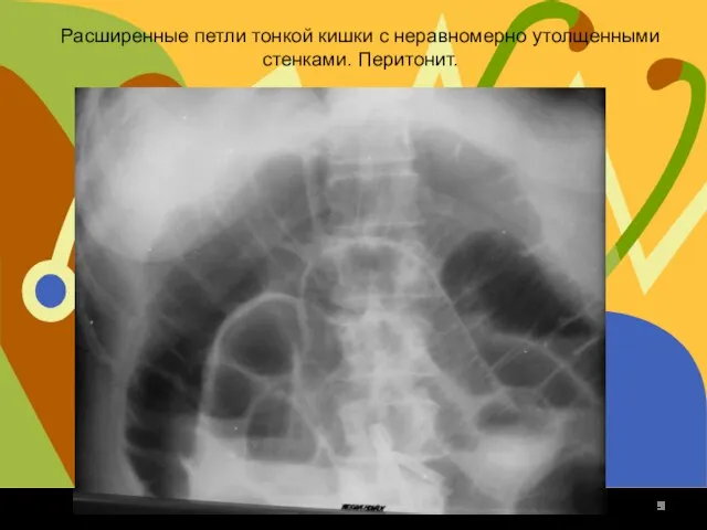 Расширенные петли тонкой кишки с неравномерно утолщенными стенками. Перитонит.