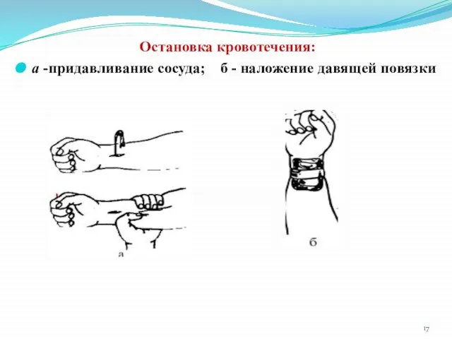 Остановка кровотечения: а -придавливание сосуда; б - наложение давящей повязки