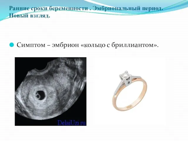 Ранние сроки беременности . Эмбриональный период. Новый взгляд. Симптом – эмбрион «кольцо с бриллиантом».