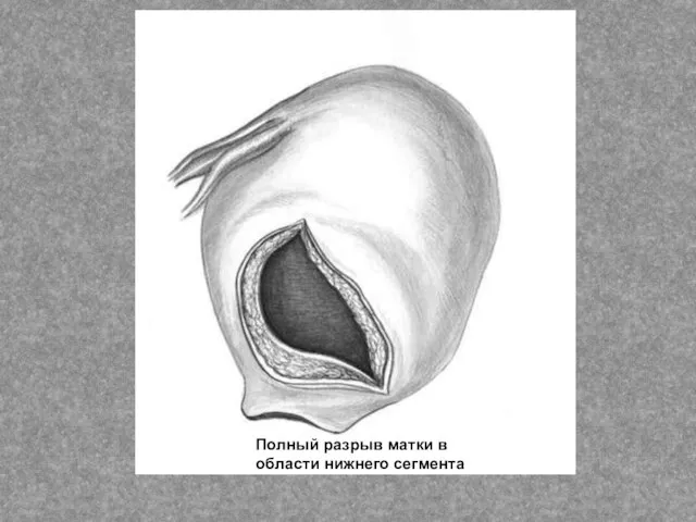 Полный разрыв матки в области нижнего сегмента