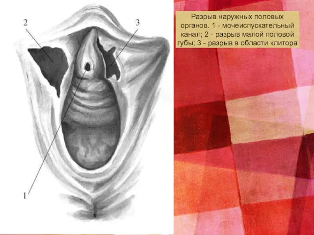 Разрыв наружных половых органов. 1 - мочеиспускательный канал; 2 - разрыв малой