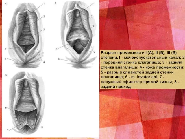 Разрыв промежности I (А), II (Б), III (В) степени.1 - мочеиспускательный канал;