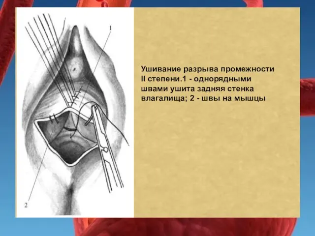 Ушивание разрыва промежности II степени.1 - однорядными швами ушита задняя стенка влагалища;