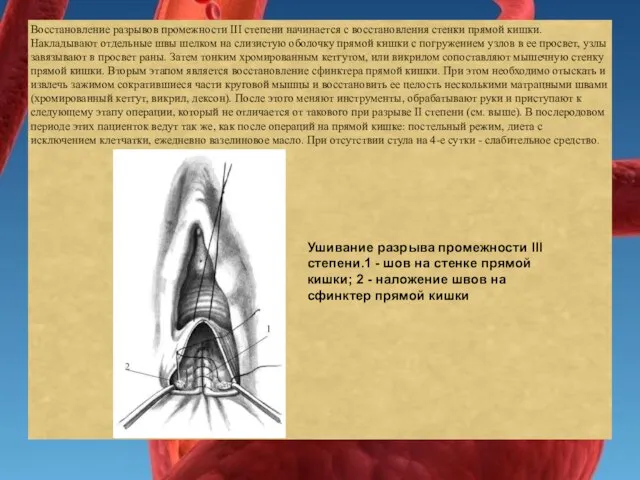 Восстановление разрывов промежности III степени начинается с восстановления стенки прямой кишки. Накладывают