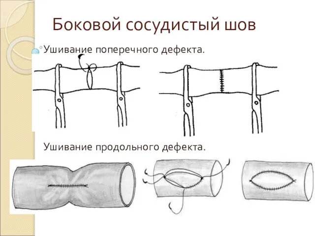 Боковой сосудистый шов Ушивание поперечного дефекта. Ушивание продольного дефекта.