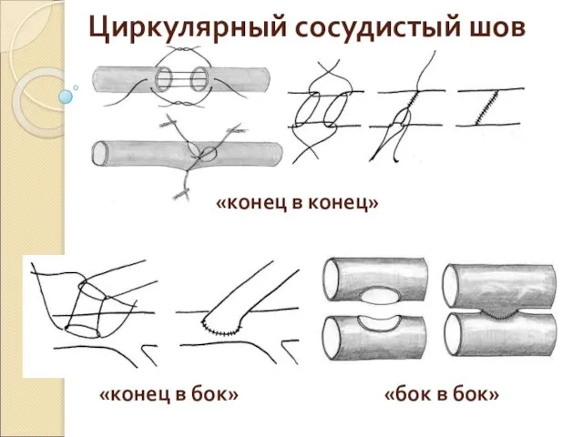 Циркулярный сосудистый шов «конец в конец» «конец в бок» «бок в бок»