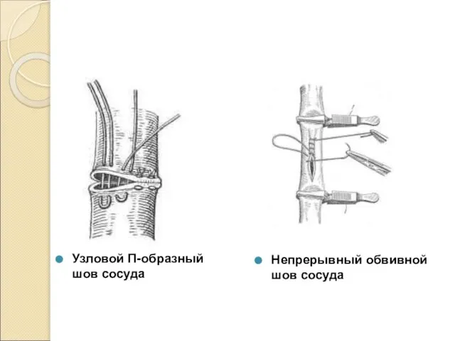 Непрерывный обвивной шов сосуда Узловой П-образный шов сосуда