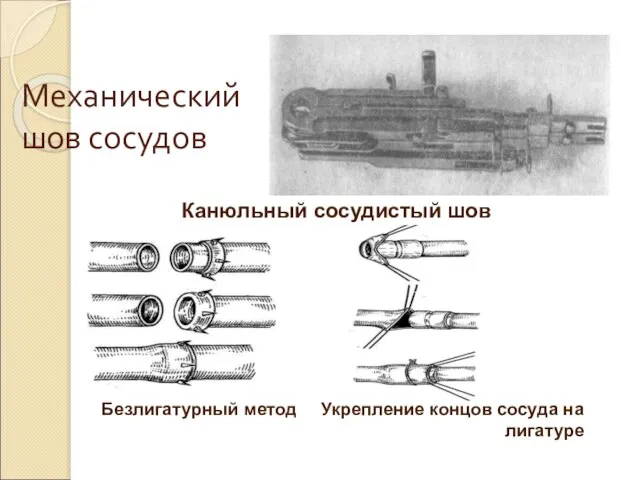 Механический шов сосудов Безлигатурный метод Укрепление концов сосуда на лигатуре Канюльный сосудистый шов