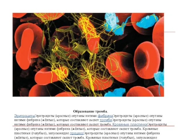 Образование тромба. ЭритроцитыЭритроциты (красные) опутаны нитями фибринаЭритроциты (красные) опутаны нитями фибрина (жёлтые),