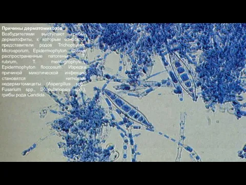Причины дерматомикозов Возбудителями выступают грибы-дерматофиты, к которым относятся представители родов Trichophyton, Microsporum,