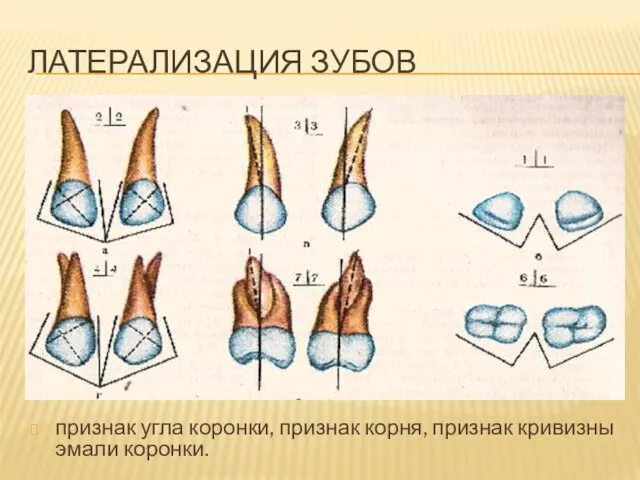 ЛАТЕРАЛИЗАЦИЯ ЗУБОВ признак угла коронки, признак корня, признак кривизны эмали коронки.