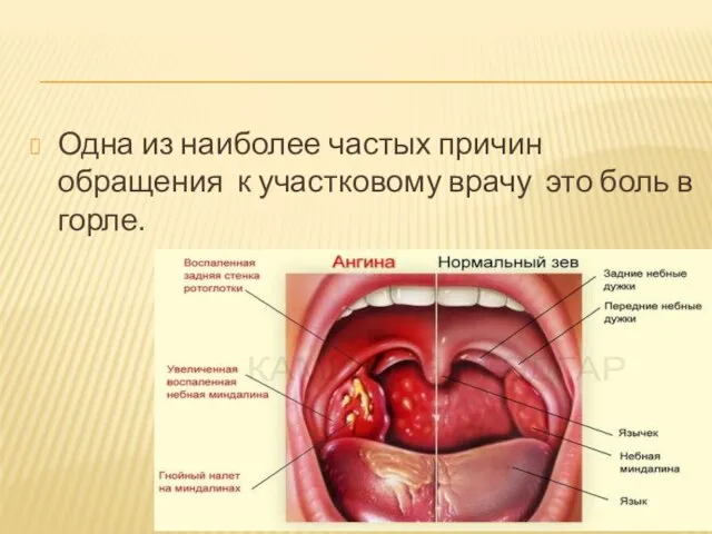 Одна из наиболее частых причин обращения к участковому врачу это боль в горле.