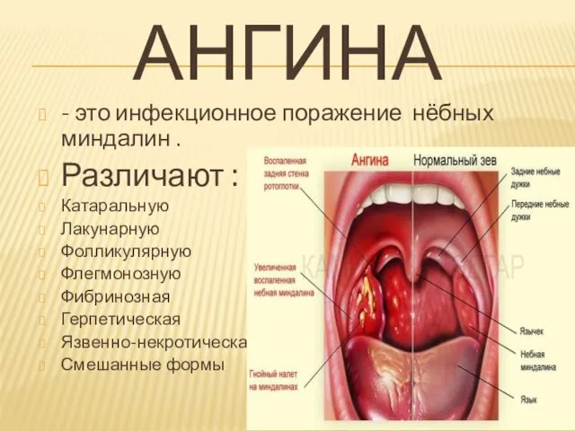 АНГИНА - это инфекционное поражение нёбных миндалин . Различают : Катаральную Лакунарную