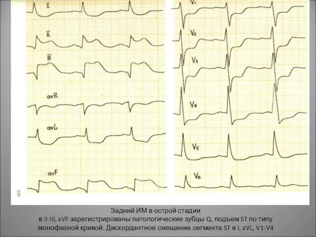 Задний ИМ в острой стадии в II-III, aVF зарегистрированы патологические зубцы Q,