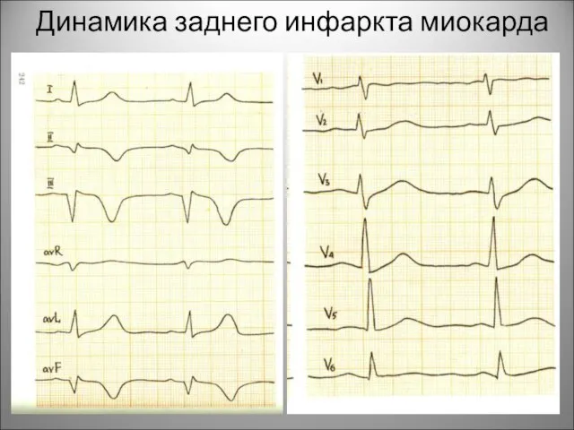Динамика заднего инфаркта миокарда