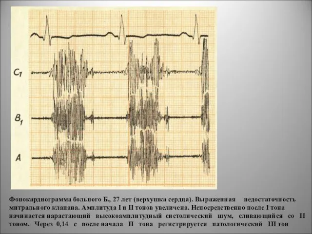 Фонокардиограмма больного Б., 27 лет (верхушка сердца). Выраженная недостаточность митрального клапана. Амплитуда