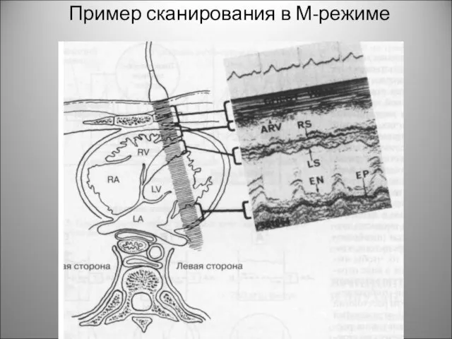 Пример сканирования в М-режиме