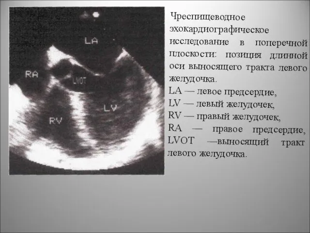 Чреспищеводное эхокардиографическое исследование в поперечной плоскости: позиция длинной оси выносящего тракта левого