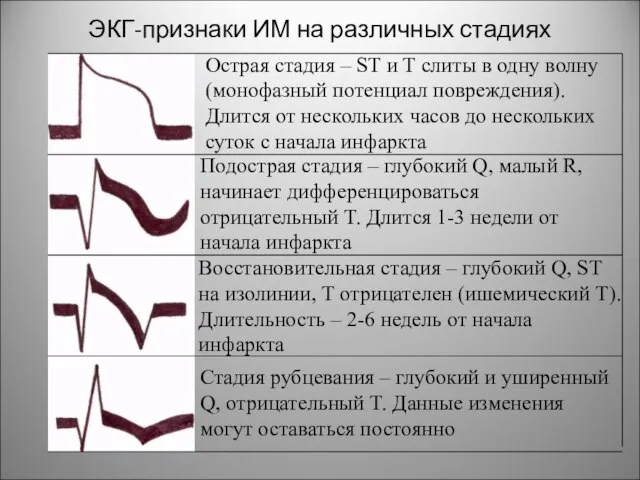 ЭКГ-признаки ИМ на различных стадиях Острая стадия – ST и T слиты