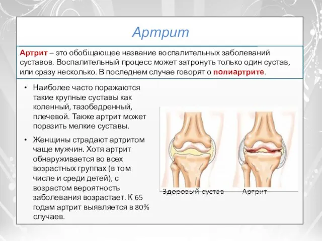 Артрит Наиболее часто поражаются такие крупные суставы как коленный, тазобедренный, плечевой. Также