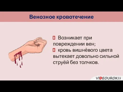 Венозное кровотечение Возникает при повреждении вен; кровь вишнёвого цвета вытекает довольно сильной струёй без толчков.