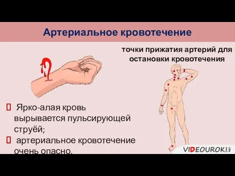 Артериальное кровотечение Ярко-алая кровь вырывается пульсирующей струёй; артериальное кровотечение очень опасно. точки