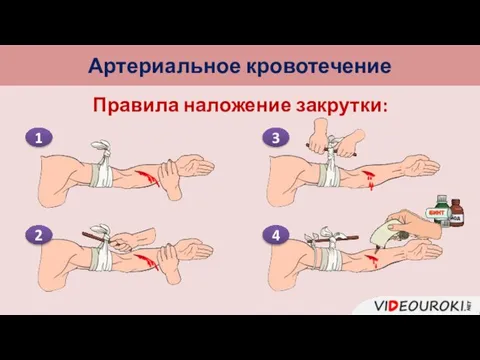 Артериальное кровотечение Правила наложение закрутки: 1 2 3 4